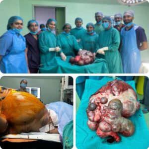 A woman weighs 17 kg from the womb. ESIC hospital doctors who removed the tumor